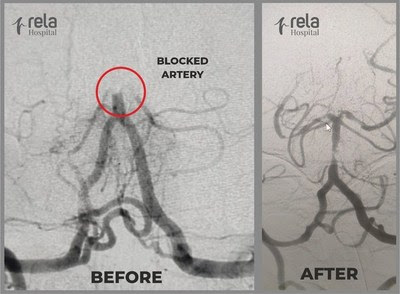 Mechanical Thrombectomy – a Treatment of Choice for Acute Ischemic Stroke